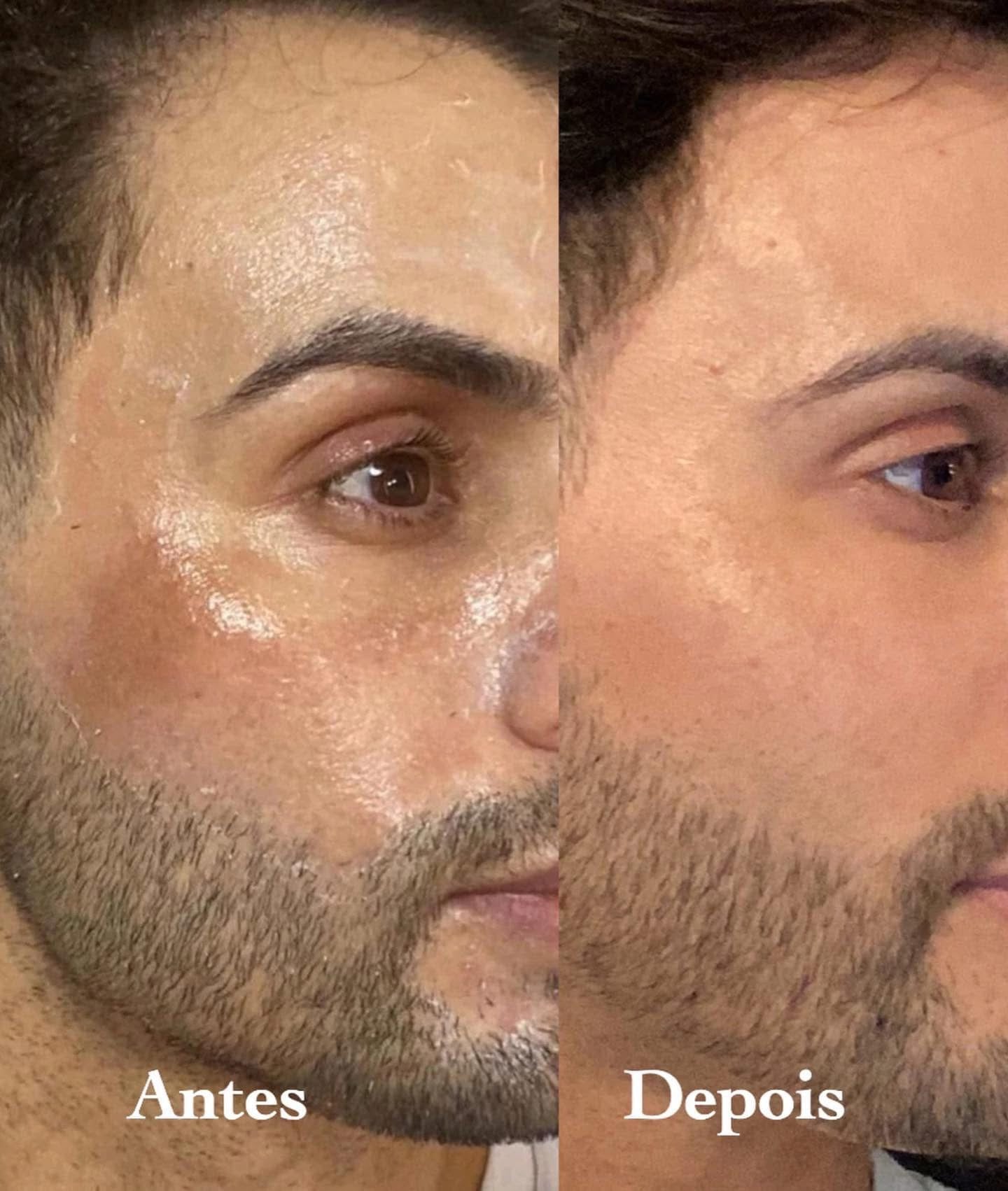 Kit Clareador de Melasma
